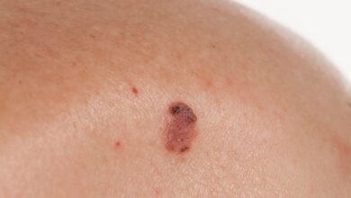 Photo of Skin Cancer Is Exploding in the U.S. – Spot These Warning Signs Before It’s Too Late