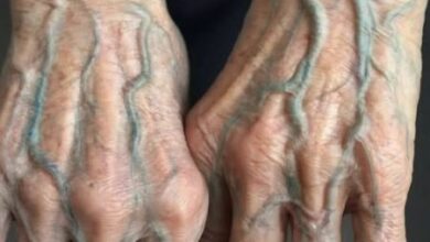 Photo of Visible Veins on Your Hands: Normal Sign or Hidden Health Red Flag?