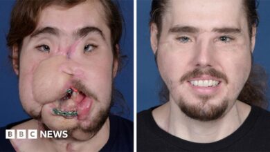 Photo of Shot in the Face at 24 — Then a 25-Hour Miracle Gave Him a New Face and a Second Life!