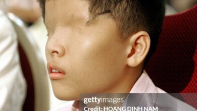 Photo of Born Blind Because of a War That Ended 50 Years Ago – The Heartbreaking Truth About Agent Orange’s Living Victims