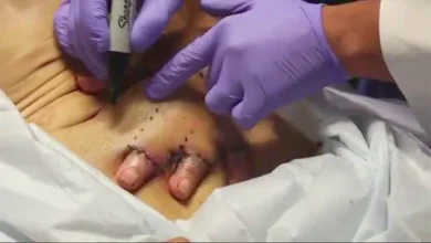 Photo of Crushed Fingers Saved from Amputation: Doctors Stitch Hand to Man’s Stomach in Mind-Blowing Surgery