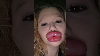 Photo of $49,000 Lip Filler Nightmare: Influencer Admits She Can’t Close Her Mouth Anymore