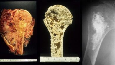 Photo of Sunburst on X-Ray: The Dramatic and Deadly Sign of Aggressive Bone Cancer
