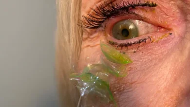 Photo of “23 Contact Lenses Fused Together Inside Elderly Woman’s Eye Like a Second Pupil – Doctor Left Speechless”