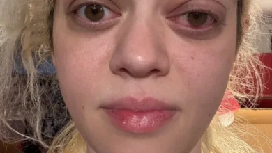 Photo of Her Eyes Started Popping Out of Their Sockets – Doctors Reveal the Shocking Truth Behind Courtney West’s Face Deformity