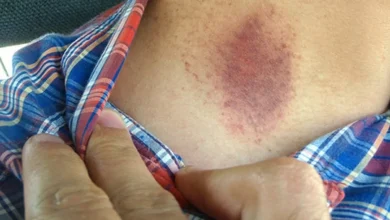 Photo of “Teenager from Mexico City Killed by a Hickey – Doctors Reveal How It Triggered a Deadly Blood Clot and Stroke”