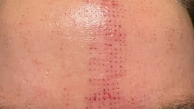 Photo of “Sarah Kabalka’s Warning: Severe Facial Burns and Lifelong Scars from Unqualified RF Microneedling Treatment”