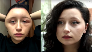 Photo of “Hair Dye Nightmare: French Student Suffers Severe Swelling After Using Supermarket Dye”