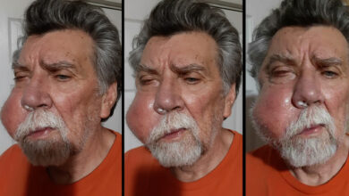Photo of Doctors Gave Him Weeks to Live — Then His Stage IV Nasal Melanoma Vanished Without Any Treatment
