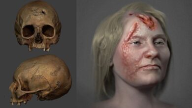 Photo of “Syphilis: When the Silent Infection Starts Eating Bone”
