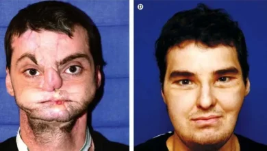 Photo of “He Shot His Own Face Off Cleaning a Gun… What Happened 15 Years Later Will Shock You”